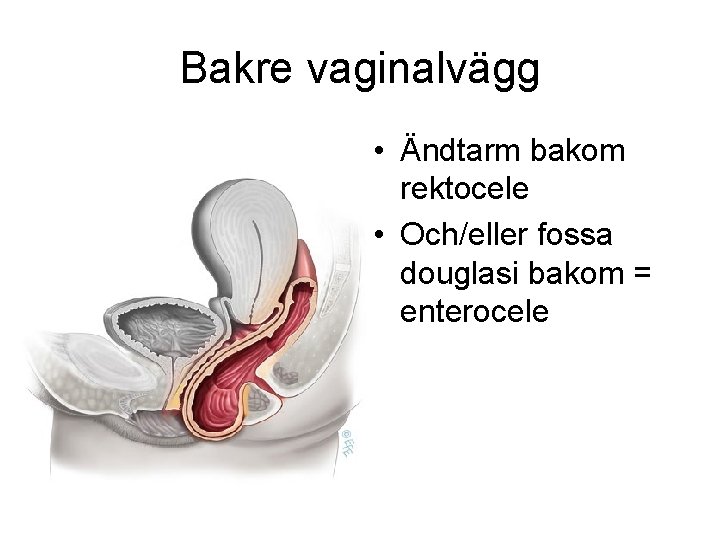Bakre vaginalvägg • Ändtarm bakom rektocele • Och/eller fossa douglasi bakom = enterocele 