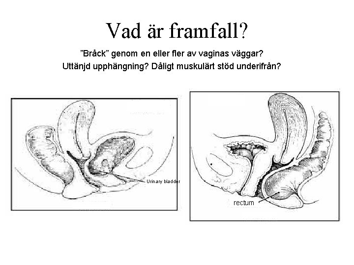 Vad är framfall? ”Bråck” genom en eller fler av vaginas väggar? Uttänjd upphängning? Dåligt