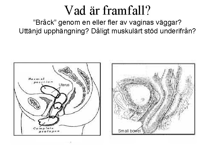 Vad är framfall? ”Bråck” genom en eller fler av vaginas väggar? Uttänjd upphängning? Dåligt