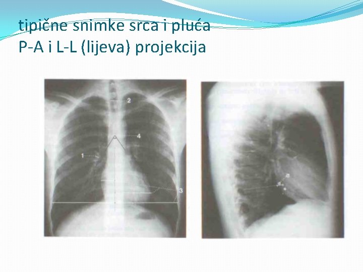 tipične snimke srca i pluća P-A i L-L (lijeva) projekcija 