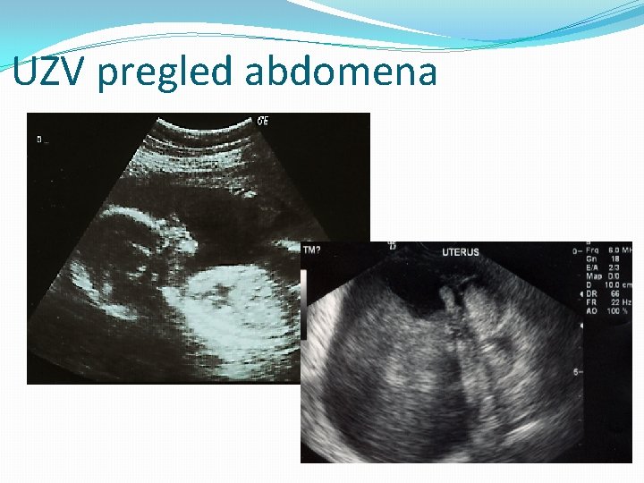 UZV pregled abdomena 