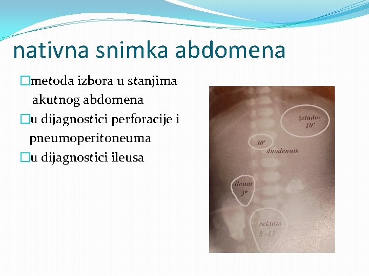 nativna snimka abdomena �metoda izbora u stanjima akutnog abdomena �u dijagnostici perforacije i pneumoperitoneuma