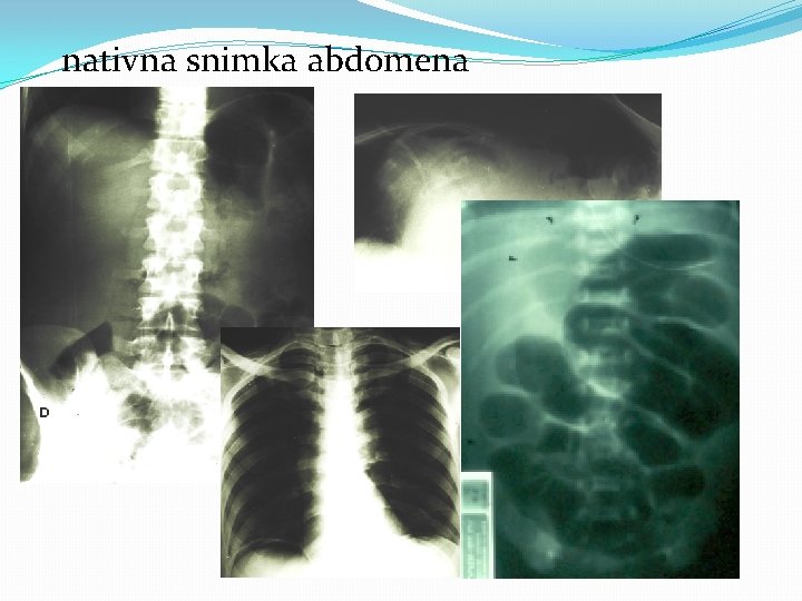 nativna snimka abdomena 