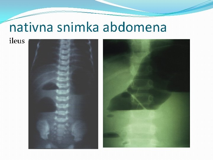 nativna snimka abdomena ileus 