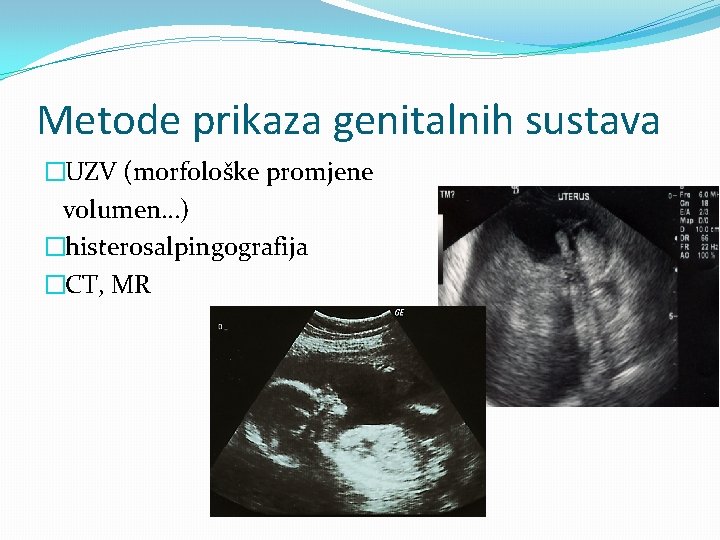 Metode prikaza genitalnih sustava �UZV (morfološke promjene volumen…) �histerosalpingografija �CT, MR 