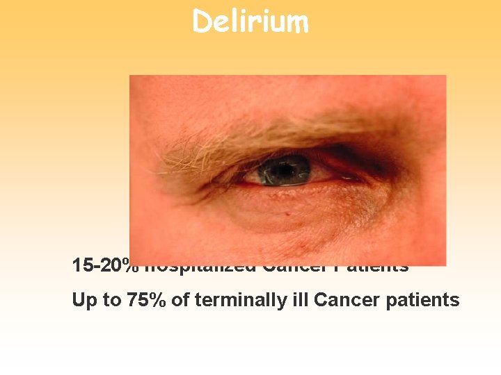 Delirium 15 -20% hospitalized Cancer Patients Up to 75% of terminally ill Cancer patients