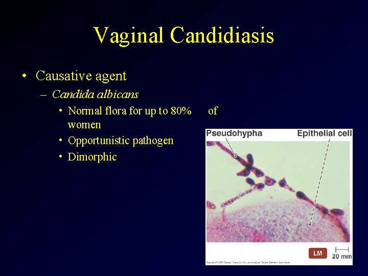 Vaginal Candidiasis • Causative agent – Candida albicans • Normal flora for up to