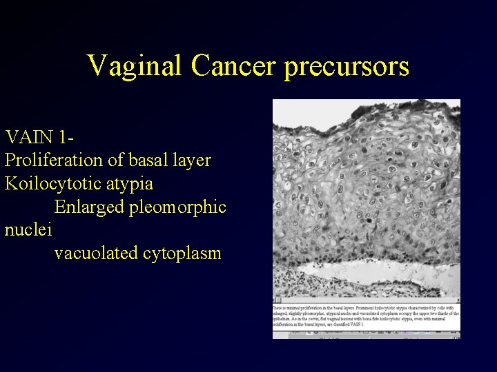 Vaginal Cancer precursors VAIN 1 Proliferation of basal layer Koilocytotic atypia Enlarged pleomorphic nuclei