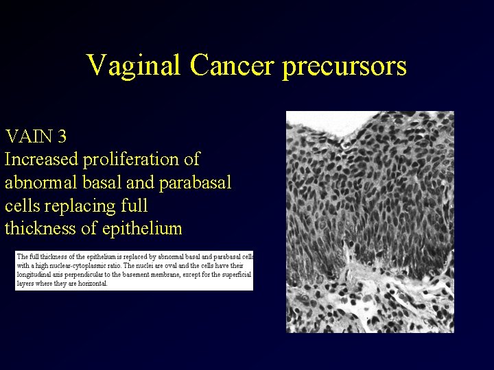Vaginal Cancer precursors VAIN 3 Increased proliferation of abnormal basal and parabasal cells replacing