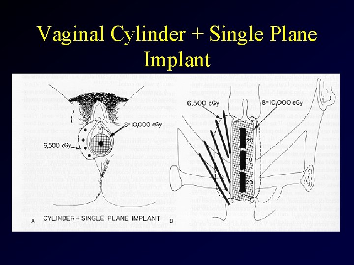 Vaginal Cylinder + Single Plane Implant 