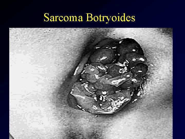 Sarcoma Botryoides 