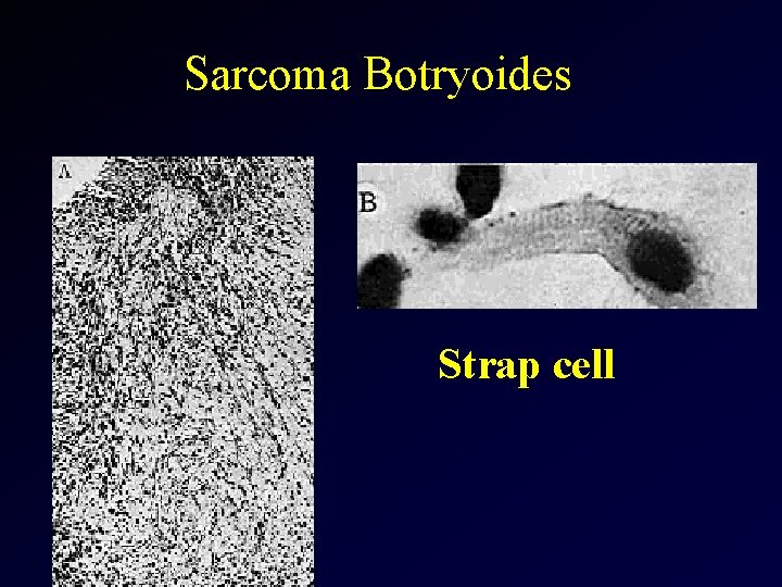 Sarcoma Botryoides Strap cell 