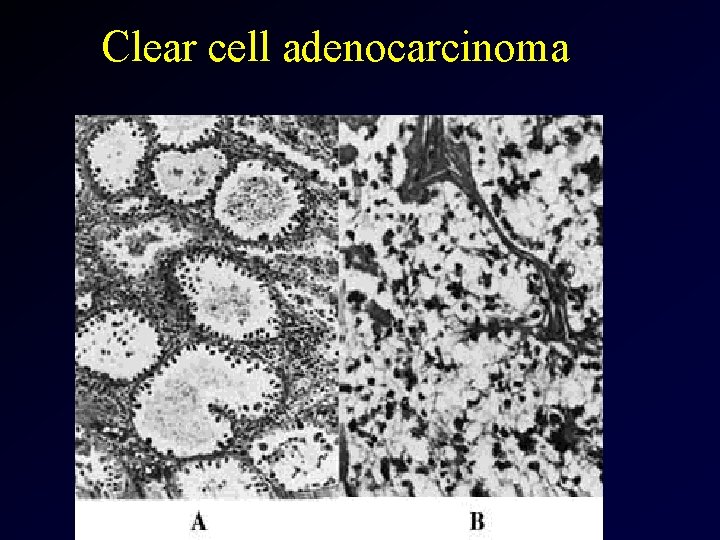 Clear cell adenocarcinoma 