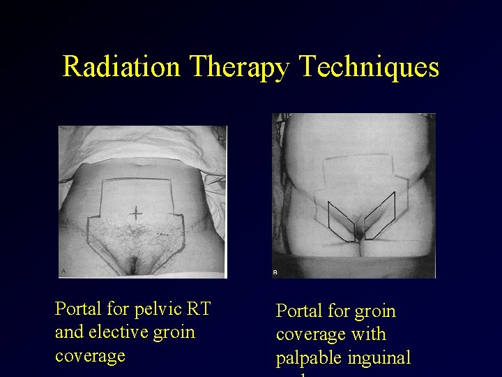Radiation Therapy Techniques Portal for pelvic RT and elective groin coverage Portal for groin
