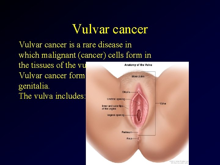 Vulvar cancer is a rare disease in which malignant (cancer) cells form in the