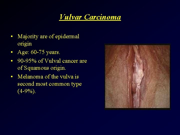 Vulvar Carcinoma • Majority are of epidermal origin • Age: 60 -75 years. •