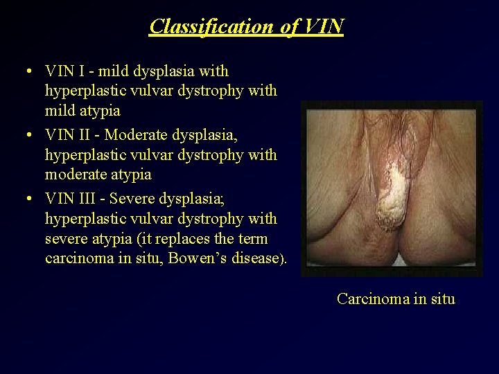 Classification of VIN • VIN I - mild dysplasia with hyperplastic vulvar dystrophy with