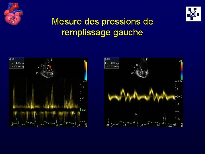 Mesure des pressions de remplissage gauche 