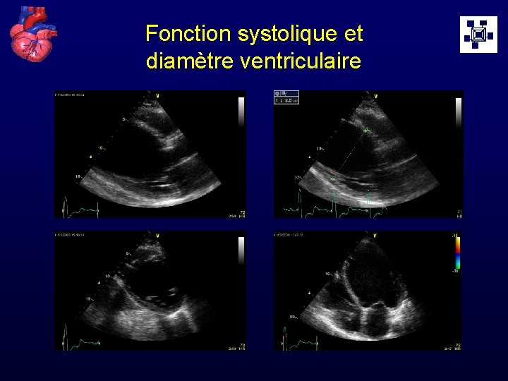Fonction systolique et diamètre ventriculaire 