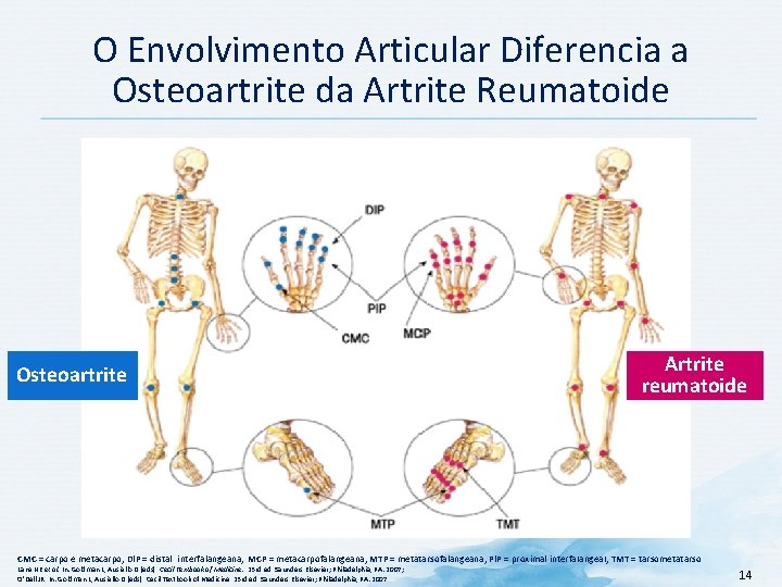 O Envolvimento Articular Diferencia a Osteoartrite da Artrite Reumatoide Osteoartrite Artrite reumatoide CMC =