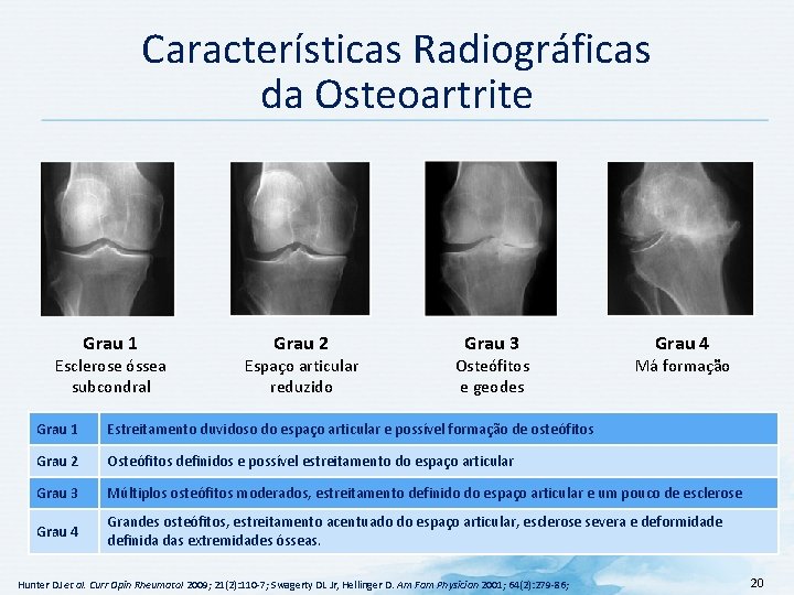 Características Radiográficas da Osteoartrite Grau 1 Esclerose óssea subcondral Grau 2 Espaço articular reduzido