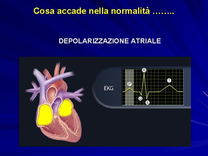 Cosa accade nella normalità ……. . DEPOLARIZZAZIONE ATRIALE 