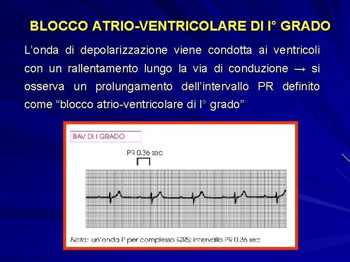 BLOCCO ATRIO-VENTRICOLARE DI I° GRADO L’onda di depolarizzazione viene condotta ai ventricoli con un