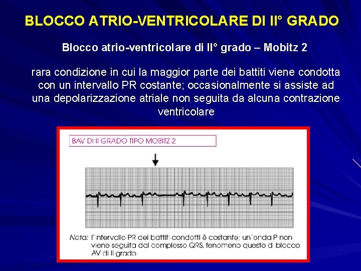 BLOCCO ATRIO-VENTRICOLARE DI II° GRADO Blocco atrio-ventricolare di II° grado – Mobitz 2 rara