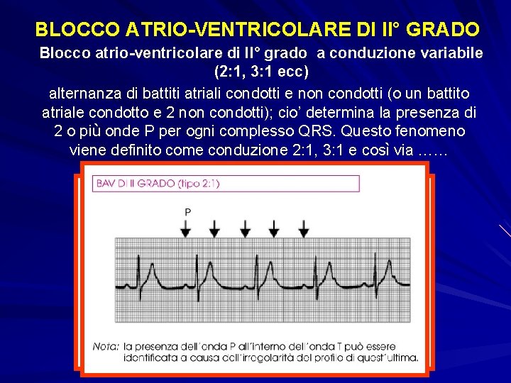 BLOCCO ATRIO-VENTRICOLARE DI II° GRADO Blocco atrio-ventricolare di II° grado a conduzione variabile (2: