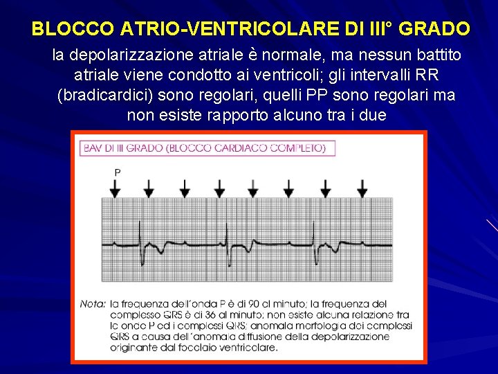 BLOCCO ATRIO-VENTRICOLARE DI III° GRADO la depolarizzazione atriale è normale, ma nessun battito atriale