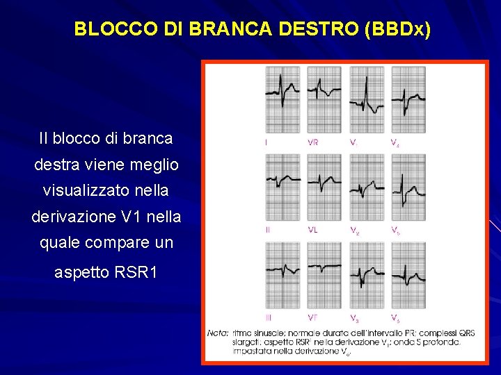 BLOCCO DI BRANCA DESTRO (BBDx) Il blocco di branca destra viene meglio visualizzato nella