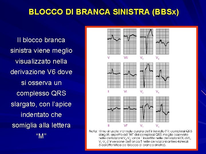 BLOCCO DI BRANCA SINISTRA (BBSx) Il blocco branca sinistra viene meglio visualizzato nella derivazione