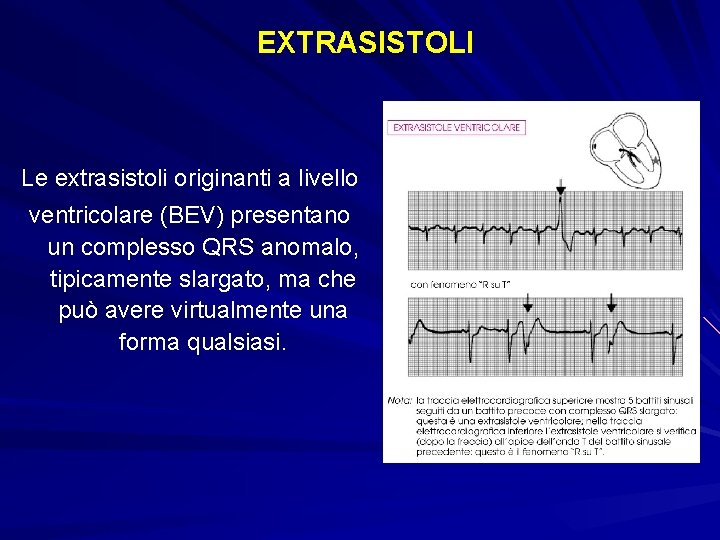 EXTRASISTOLI Le extrasistoli originanti a livello ventricolare (BEV) presentano un complesso QRS anomalo, tipicamente