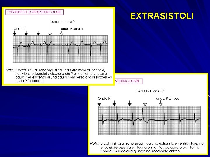 EXTRASISTOLI 