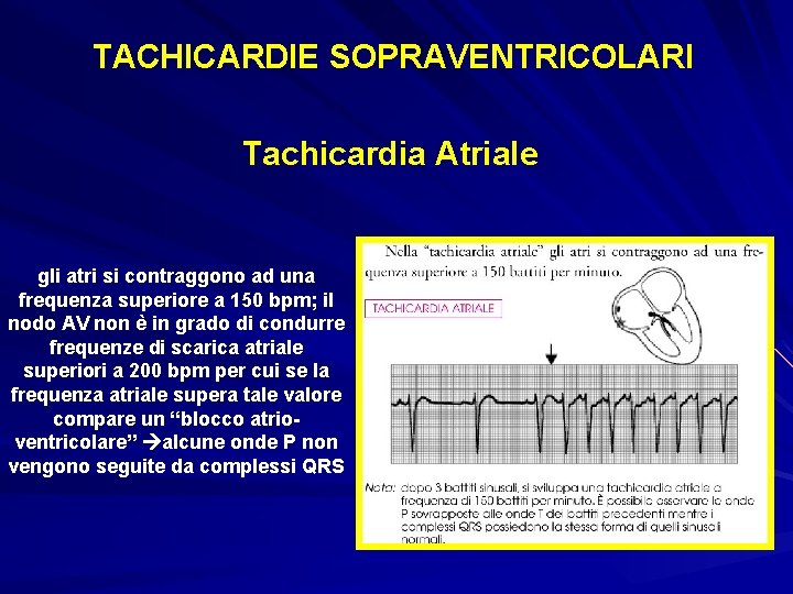 TACHICARDIE SOPRAVENTRICOLARI Tachicardia Atriale gli atri si contraggono ad una frequenza superiore a 150