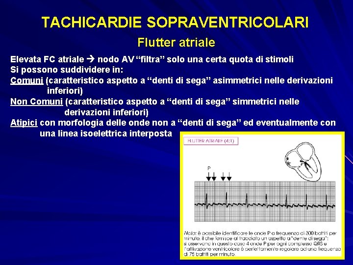 TACHICARDIE SOPRAVENTRICOLARI Flutter atriale Elevata FC atriale nodo AV “filtra” solo una certa quota