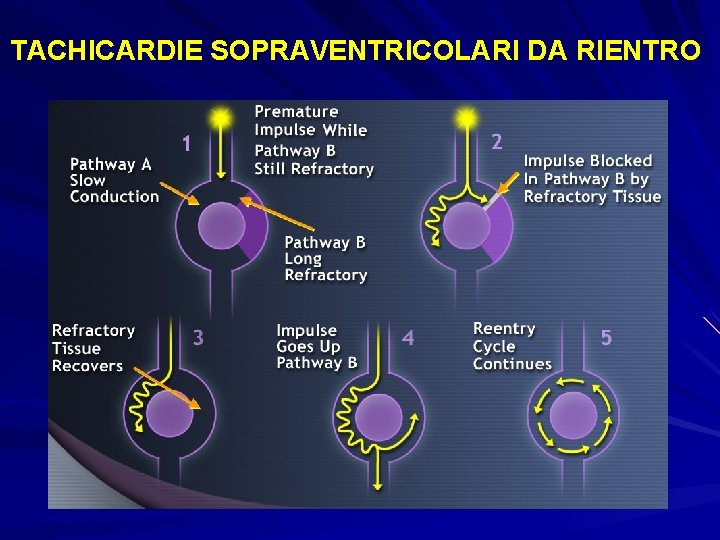 TACHICARDIE SOPRAVENTRICOLARI DA RIENTRO 