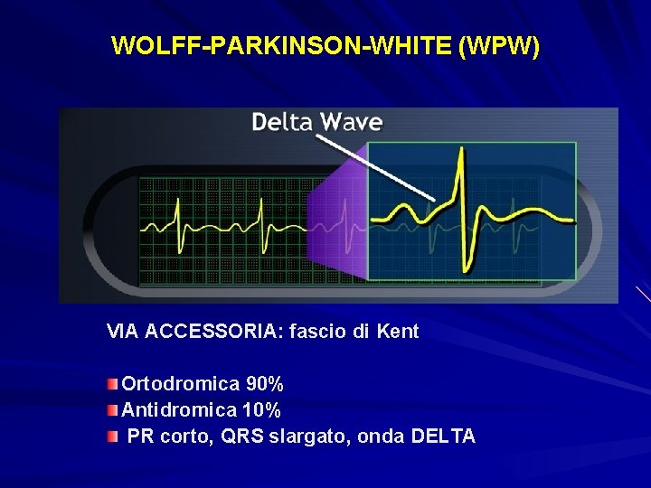 WOLFF-PARKINSON-WHITE (WPW) VIA ACCESSORIA: fascio di Kent Ortodromica 90% Antidromica 10% PR corto, QRS