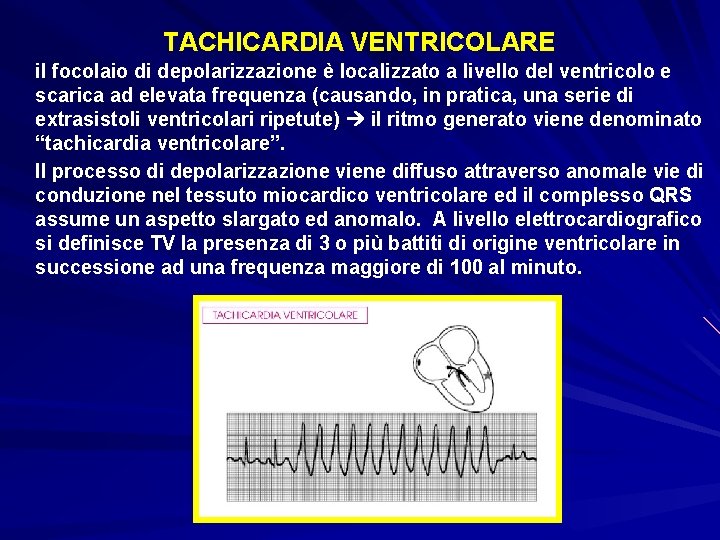 TACHICARDIA VENTRICOLARE il focolaio di depolarizzazione è localizzato a livello del ventricolo e scarica