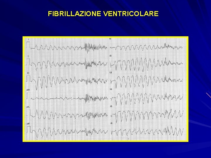 FIBRILLAZIONE VENTRICOLARE 