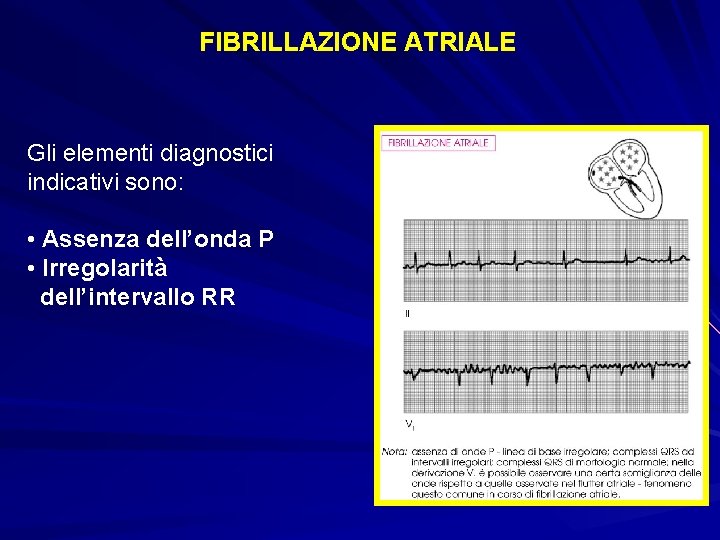 FIBRILLAZIONE ATRIALE Gli elementi diagnostici indicativi sono: • Assenza dell’onda P • Irregolarità dell’intervallo