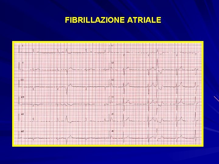 FIBRILLAZIONE ATRIALE 