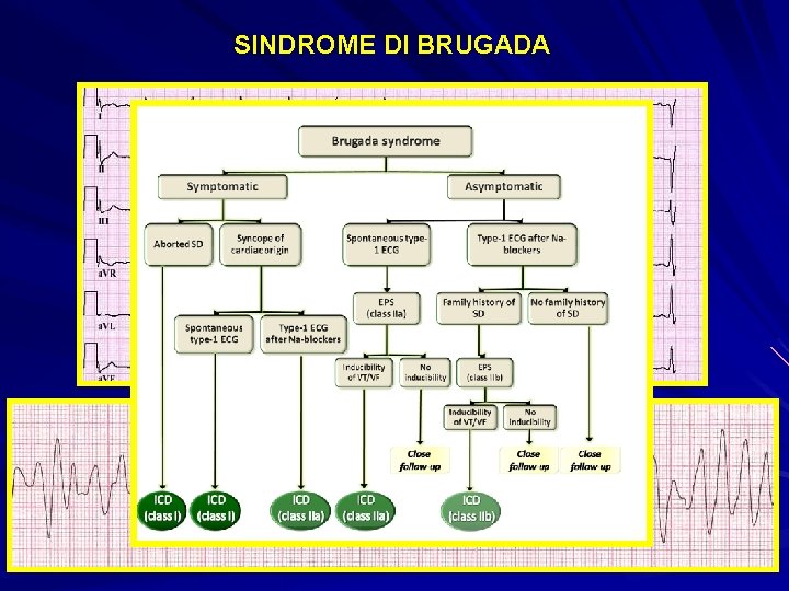 SINDROME DI BRUGADA 