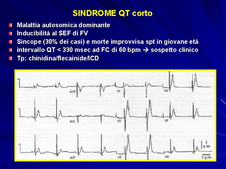 SINDROME QT corto Malattia autosomica dominante Inducibilità al SEF di FV Sincope (30% dei