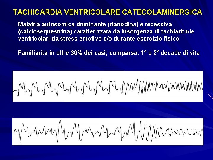 TACHICARDIA VENTRICOLARE CATECOLAMINERGICA Malattia autosomica dominante (rianodina) e recessiva (calciosequestrina) caratterizzata da insorgenza di