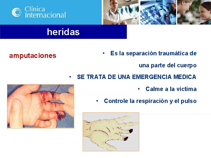 heridas amputaciones • Es la separación traumática de una parte del cuerpo • SE