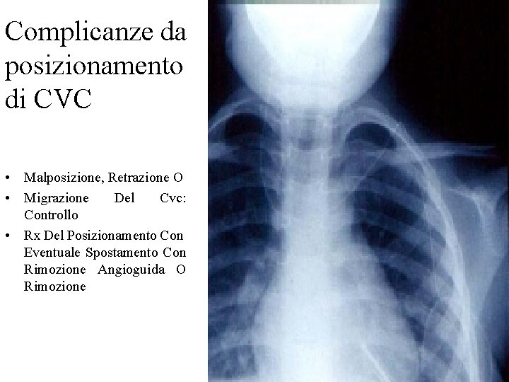 Complicanze da posizionamento di CVC • Malposizione, Retrazione O • Migrazione Del Cvc: Controllo