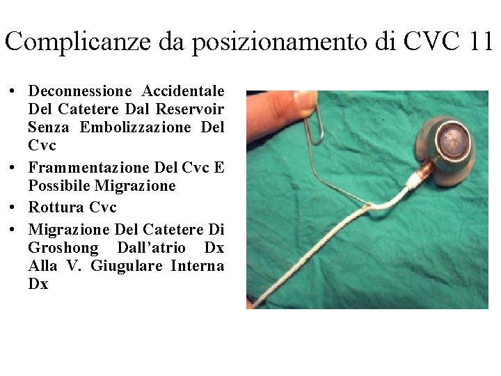 Complicanze da posizionamento di CVC 11 • Deconnessione Accidentale Del Catetere Dal Reservoir Senza