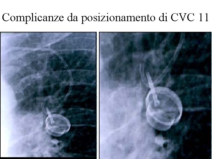 Complicanze da posizionamento di CVC 11 