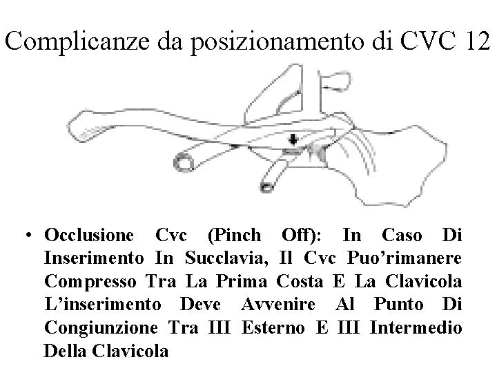 Complicanze da posizionamento di CVC 12 • Occlusione Cvc (Pinch Off): In Caso Di